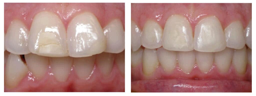 Invisalign in Ashland VA