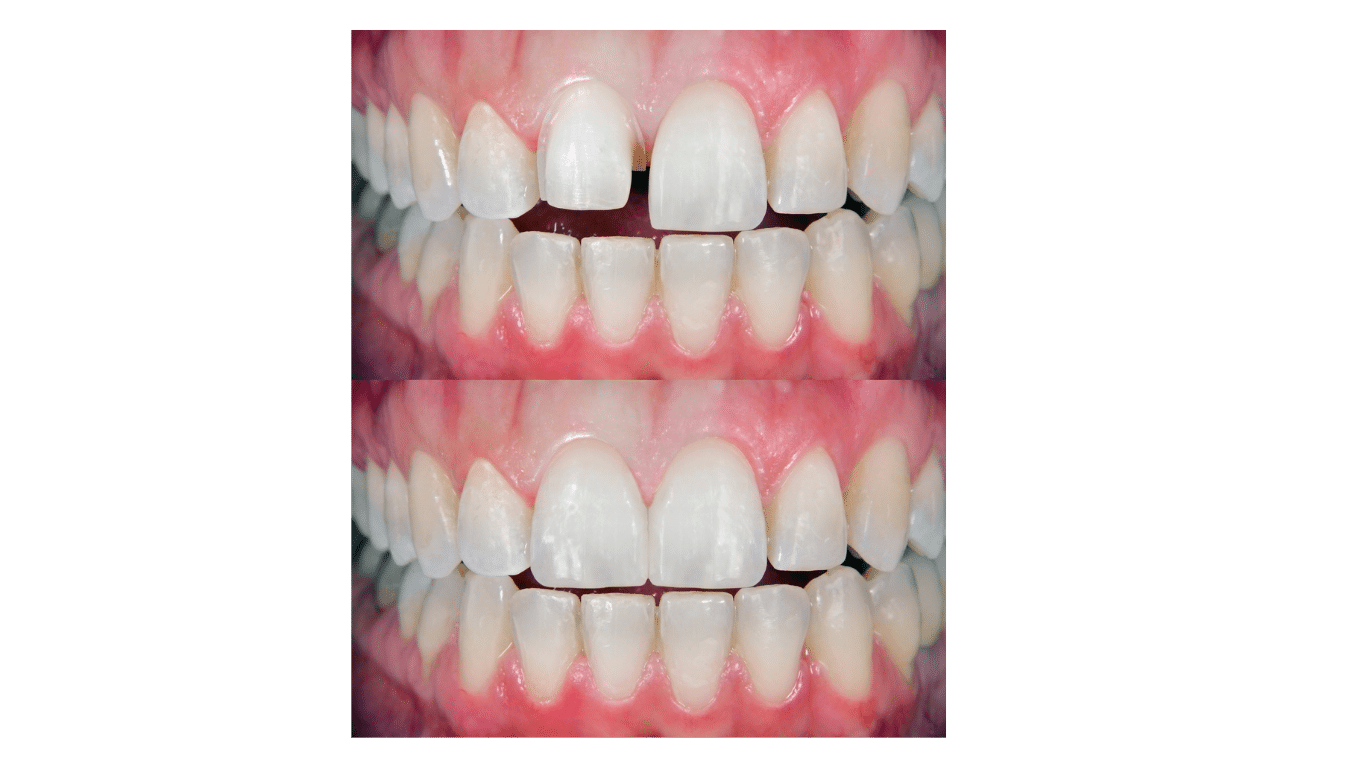 Dental Veneers Ashland VA